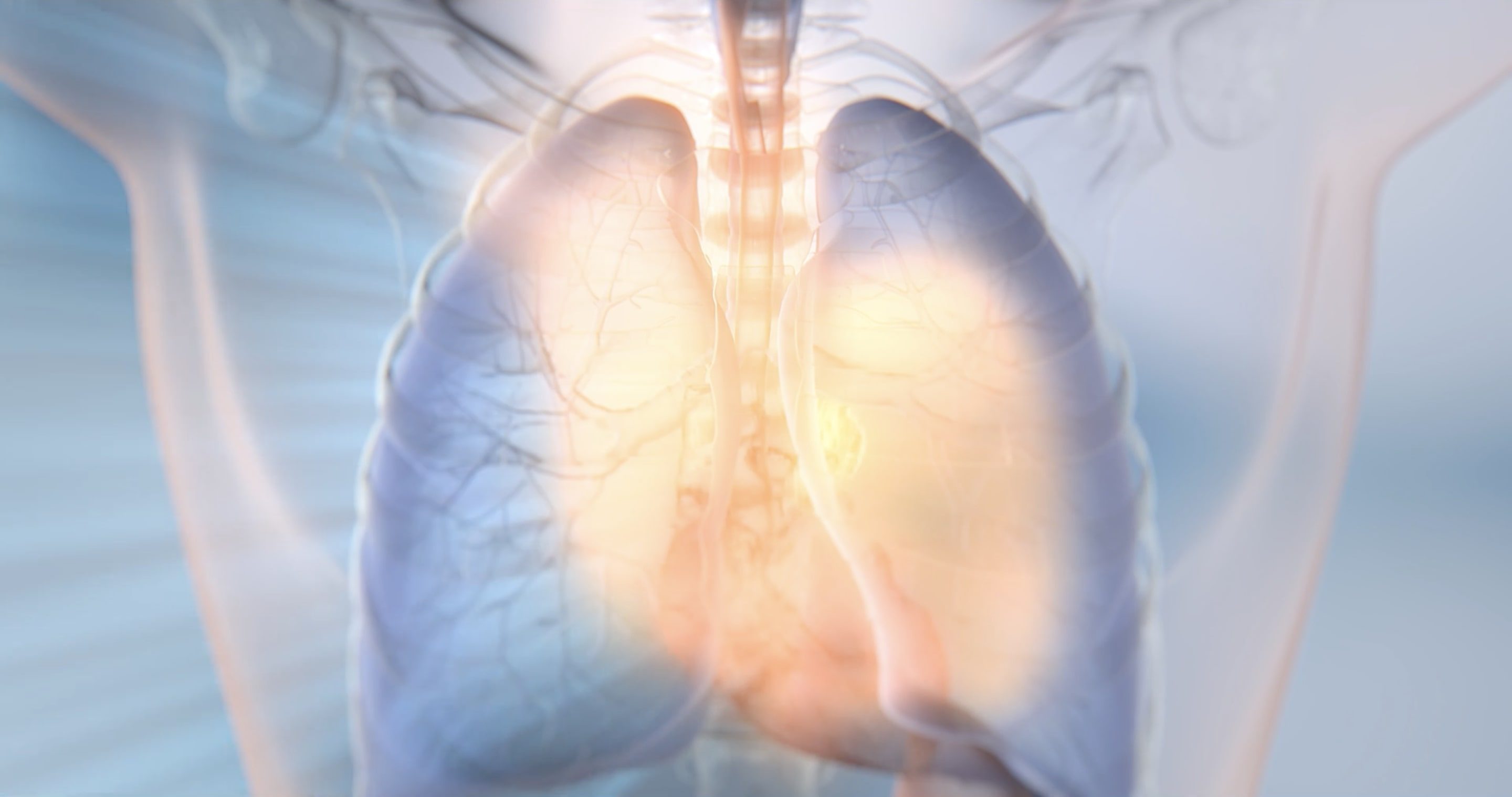 A 3D reconstruction of a lung cancer